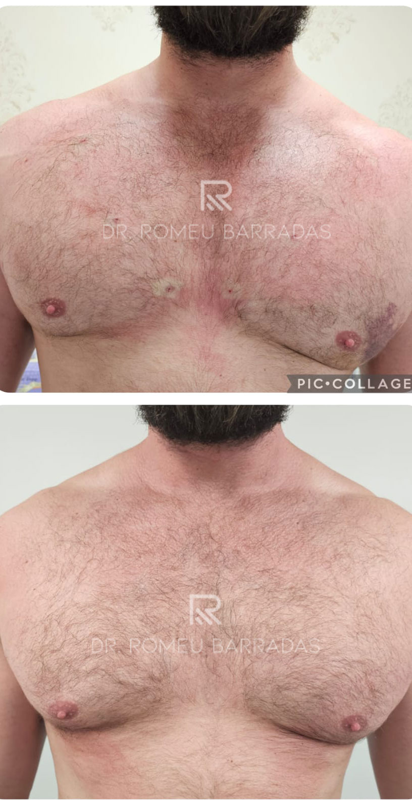 preenchimento-peitoral-2