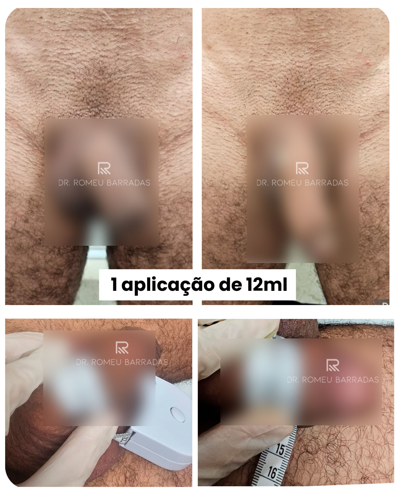 01-blur